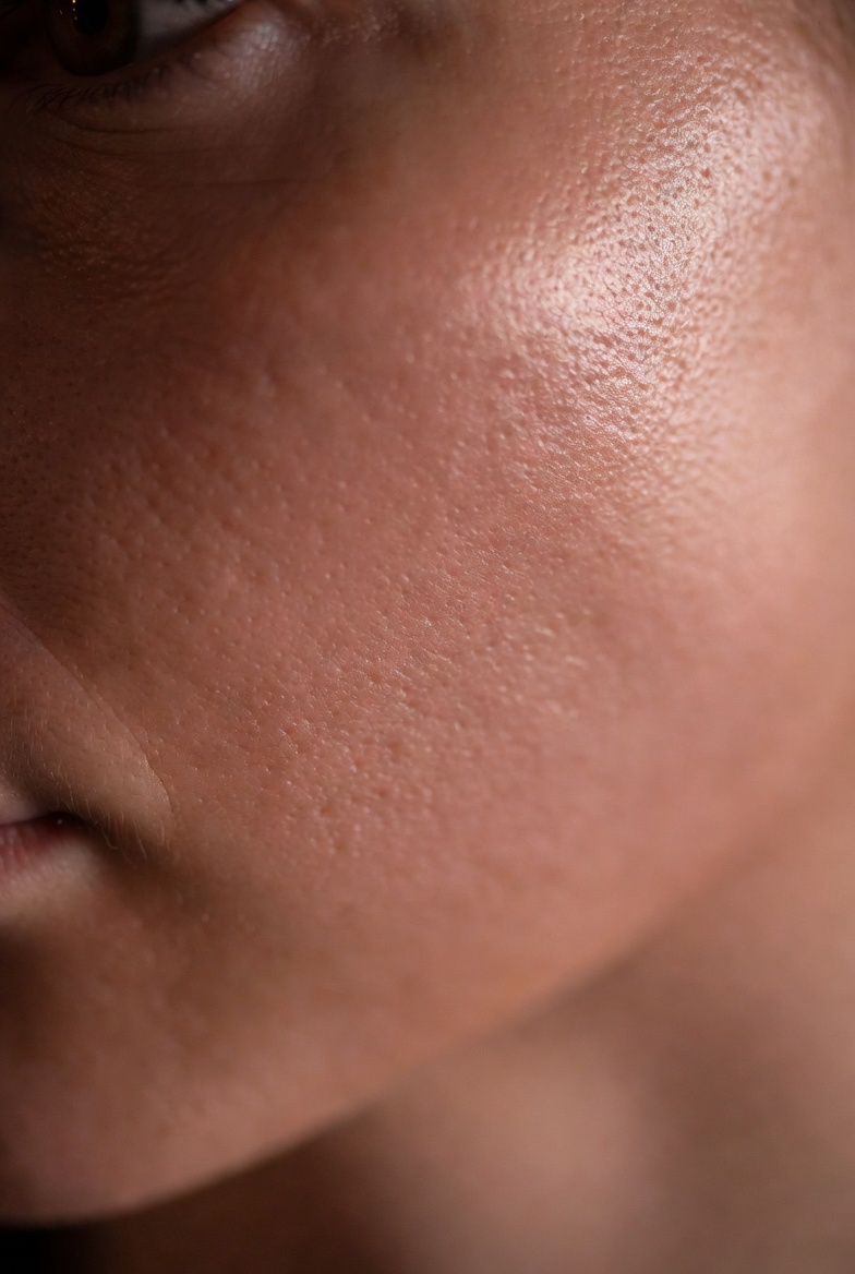 Acne scar improvement after microneedling — Millstone Aesthetics Greenville SC